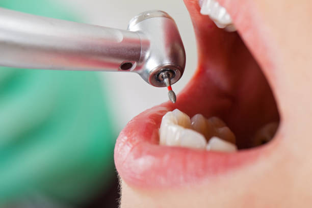 Best Knocked-Out Tooth (Avulsed Tooth) Treatment in Umatilla, FL